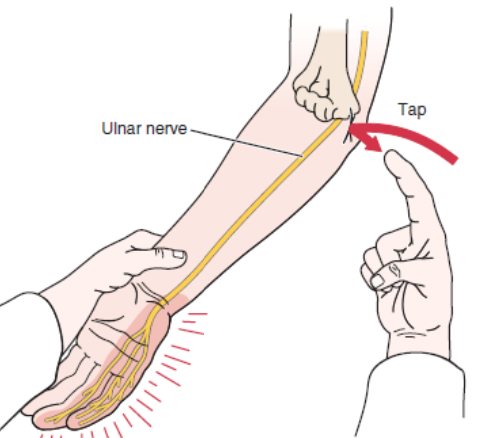<ul><li><p><span>PURPOSE- Identifies dysfunction of ulnar nerve at olecranon</span></p></li><li><p><span>DESCRIPTION- The area of the ulnar nerve in the groove is tapped.</span></p></li><li><p><span>RESULT- A positive sign is indicated by a tingling sensation in the ulnar distribution of the forearm and hand distal to the point of compression of the nerve. The test indicates the point of regeneration of the sensory fibers of a nerve. The most distal point at which the patient feels the abnormal</span></p><p><span>sensation represents the limit of nerve regeneration</span></p></li></ul><p></p>