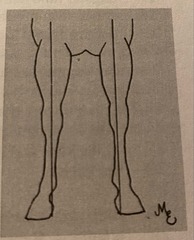 <p>What is this stance and a common DDx for it?</p>