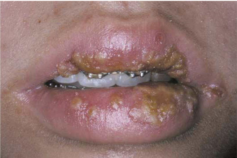 <p>what is this lesion associated with and how did it form</p>