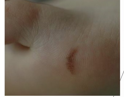 <p>Acral Melanoma: </p><ul><li><p>rapid change/evolution</p></li><li><p>consider biopsy >7mm, rapidly growing, or concerning features on dermoscopy</p></li></ul><p>MIMIC: Acral Nevus</p><ul><li><p>likely benign <7mm; dermoscopy reassuring (parallel fullow/lattice pattern)</p></li></ul><p></p>