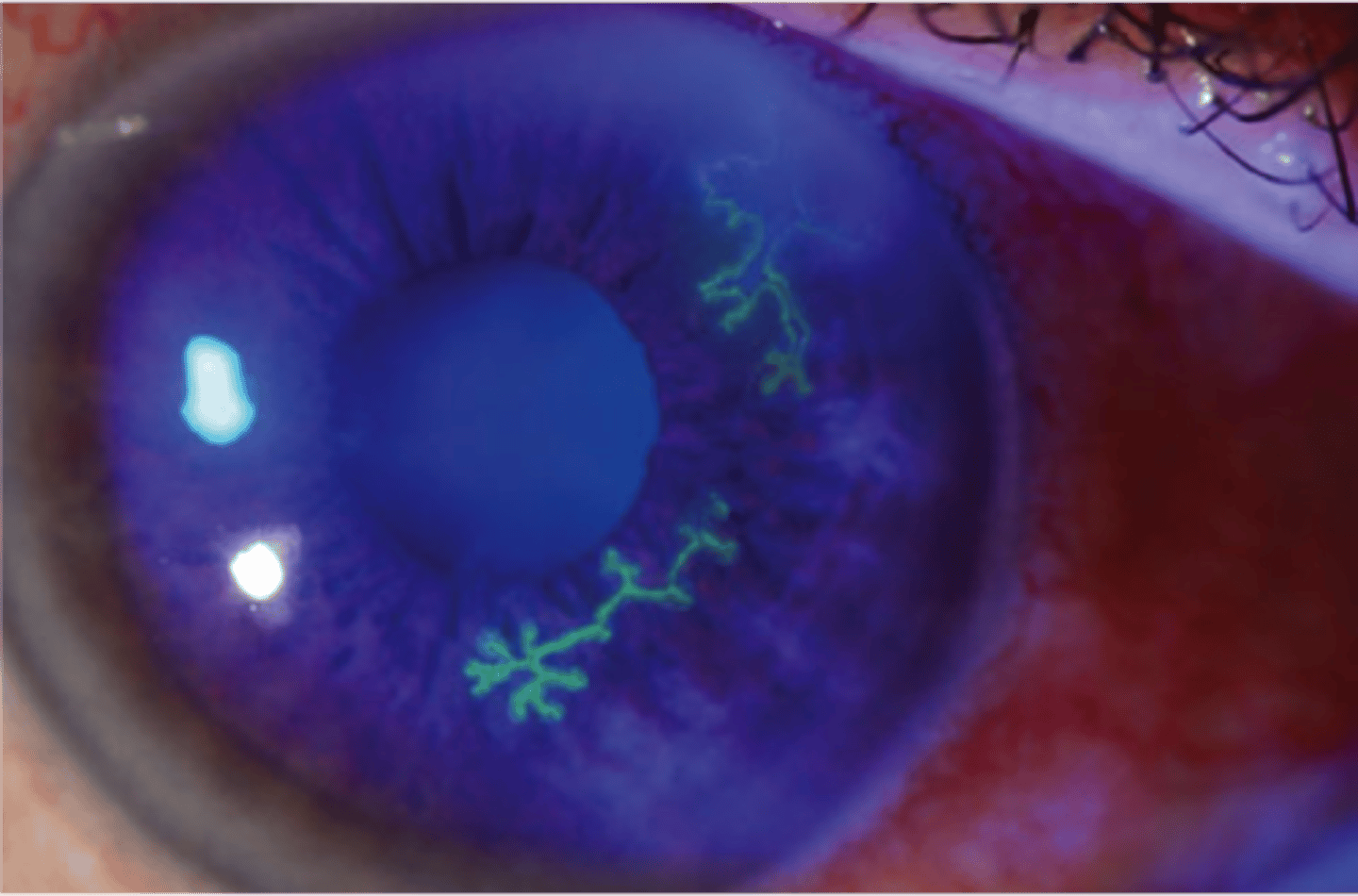 <p>Dendritic ulcers are associated with the herpes simplex virus (HSV). The edges may be slightly elevated due to swollen epithelial cells.</p>