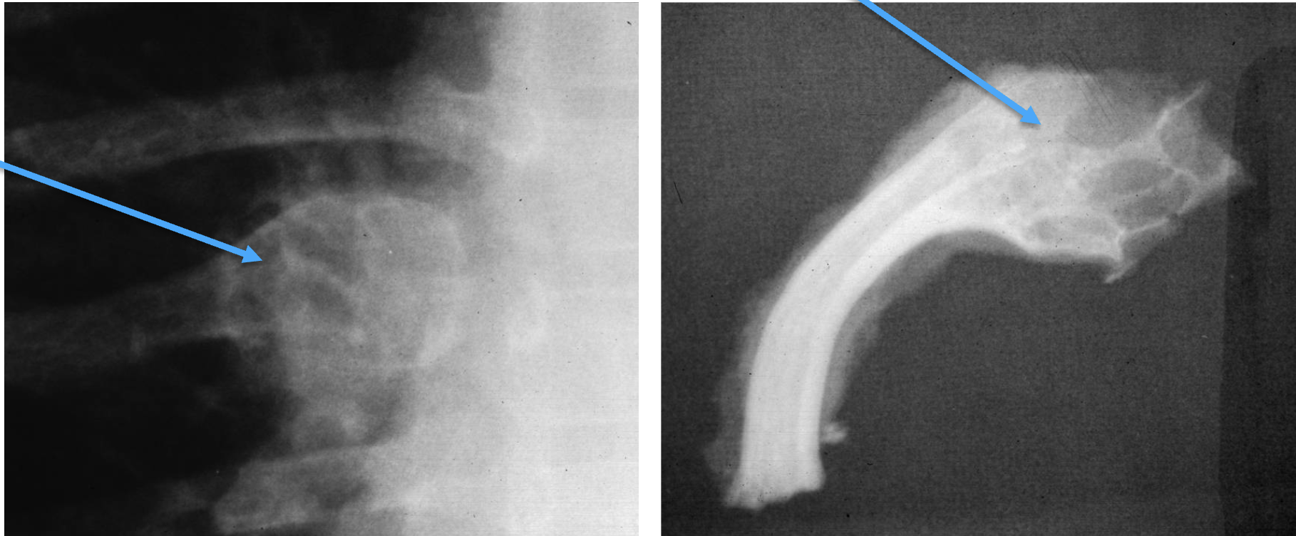 <p>What tumour-like condition is this, what bone is it in and what can be seen?</p>
