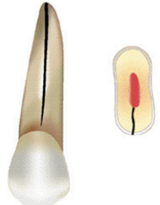 <p>What is a vertical root fracture?</p>