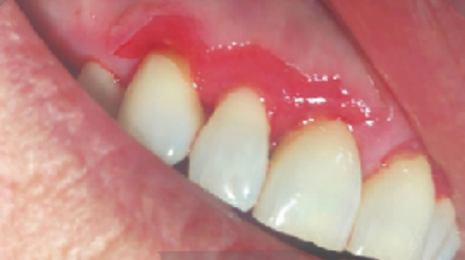 <p>condition where the <strong>gingiva </strong>becomes eroded and sloughs off, often as a result of autoimmune diseases.</p>