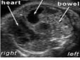 <ul><li><p>m/c </p></li><li><p>fluid filled stomach/distended loops of vowel in left chest</p></li><li><p>dextroposition of heart or mediastinal shift</p></li></ul><p></p>