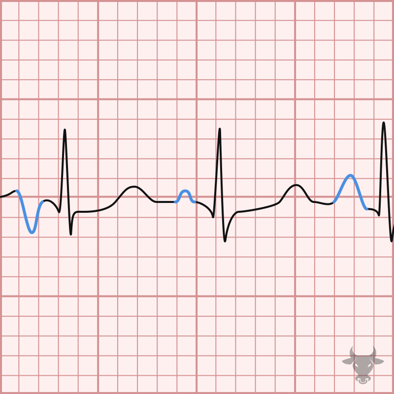 <p>Multiple atrial automaticity foci.</p>