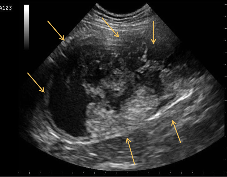 <p>This is a 14-year-old, neutered male Malinois presenting with a history</p><p class="p1">of hemangiosarcoma of the tongue and scrotum. The patient also</p><p class="p1">underwent a splenectomy for the same reason a year ago. Currently</p><p class="p1">the patient is showing hematuria. What does the following longitudinal</p><p class="p1">scan of the urinary bladder show?</p>
