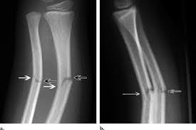 <p>What is a greenstick fracture?</p>