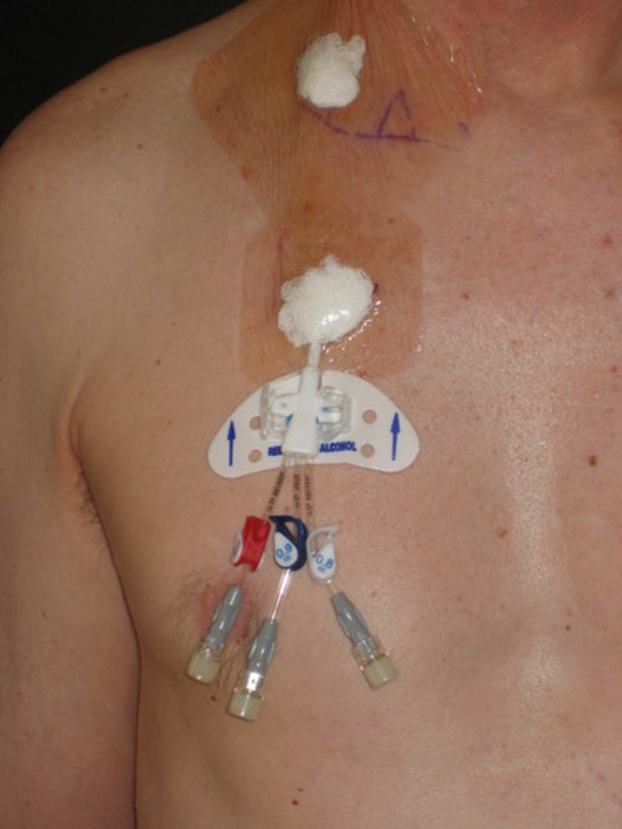 <p>-central line tunneled under the skin</p><p>-provides antibiotics, nutritional solutions and blood samples</p>
