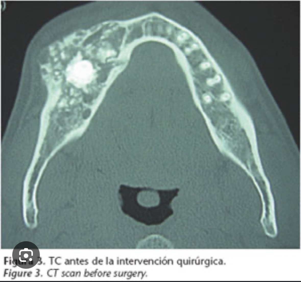 <p><span>Radiolucidez con áreas radiopacas calcificadas.</span></p>