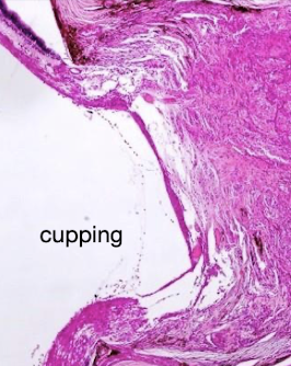 <ul><li><p><strong>Buphthalmus</strong></p></li><li><p><strong>Retinal changes</strong></p><ul><li><p>Atrophy</p></li><li><p>Cupping of the optic disc</p></li><li><p>Degeneration of the optic nerve (in severe cases)</p></li></ul></li><li><p><strong>Uveal changes</strong></p><ul><li><p>Retraction and collapse of the filtration angle</p></li></ul></li><li><p><strong>Corneal changes</strong></p><ul><li><p>Edema from endothelial loss</p></li><li><p>Striae from breaks in Descemet’s membrane</p></li><li><p>Exposure keratitis</p></li></ul></li></ul><p>do not need all of these to diagnose glaucoma</p>