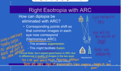 <p>Why can diplopia be eliminated with anomalous retinal correspondence (ARC)?</p>