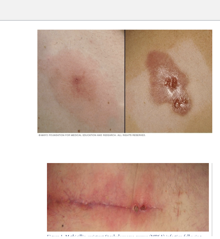 <ul><li><p>Starts as swollen, painful red bumps that may resemble pimples or spider bites.</p></li><li><p>Lesions can feel warm and may contain pus.</p></li><li><p>fever</p></li><li><p>progresses to deep, painful boils.</p></li></ul><p></p>