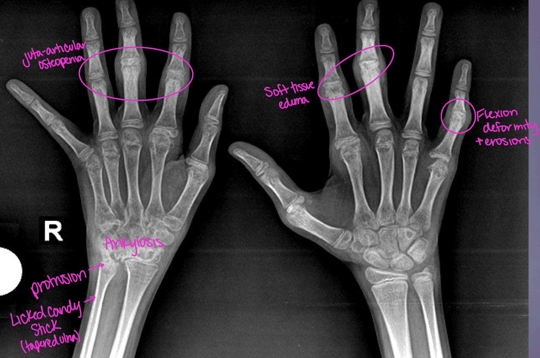 <p>This young female presented with stiffness and pain in both wrists, limitation of movement in both wrists (esp. right side), what diagnosis would you give her</p>
