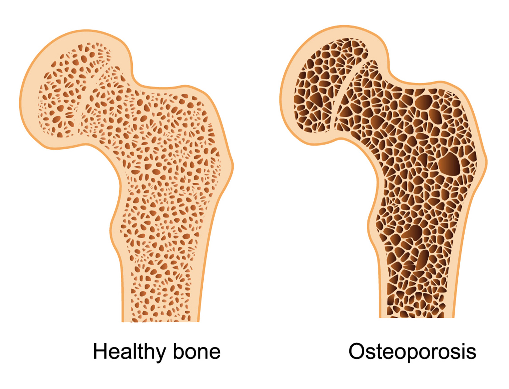 <p>A condition characterised by decreased bone density, leading to increased fracture risk.</p>