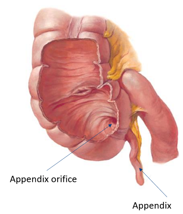 <ul><li><p><strong>Vermiform</strong> (worm-like)</p></li><li><p><strong>Variable</strong> orientation w/ its own <strong>mesentery</strong> (<strong>mesoappendix</strong>)</p></li><li><p>Prone to <strong>sudden implications</strong> → <strong>appendectomy</strong></p></li><li><p>High proportion of <strong>lymphoid tissue</strong></p></li></ul><p></p>