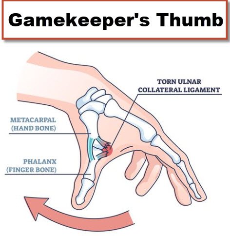 <p>Gamekeeper’s (Skier’s) Thumb: UCL sprain or Stener’s lesion resulting in complete UCL disruption w/ retraction requiring surgical fixation. </p><p>MCP collaterals will be taught in flexion.</p><p>DIP collaterals will be tensioned through flex/extension</p><p>PIP collaterals taught in extension</p>