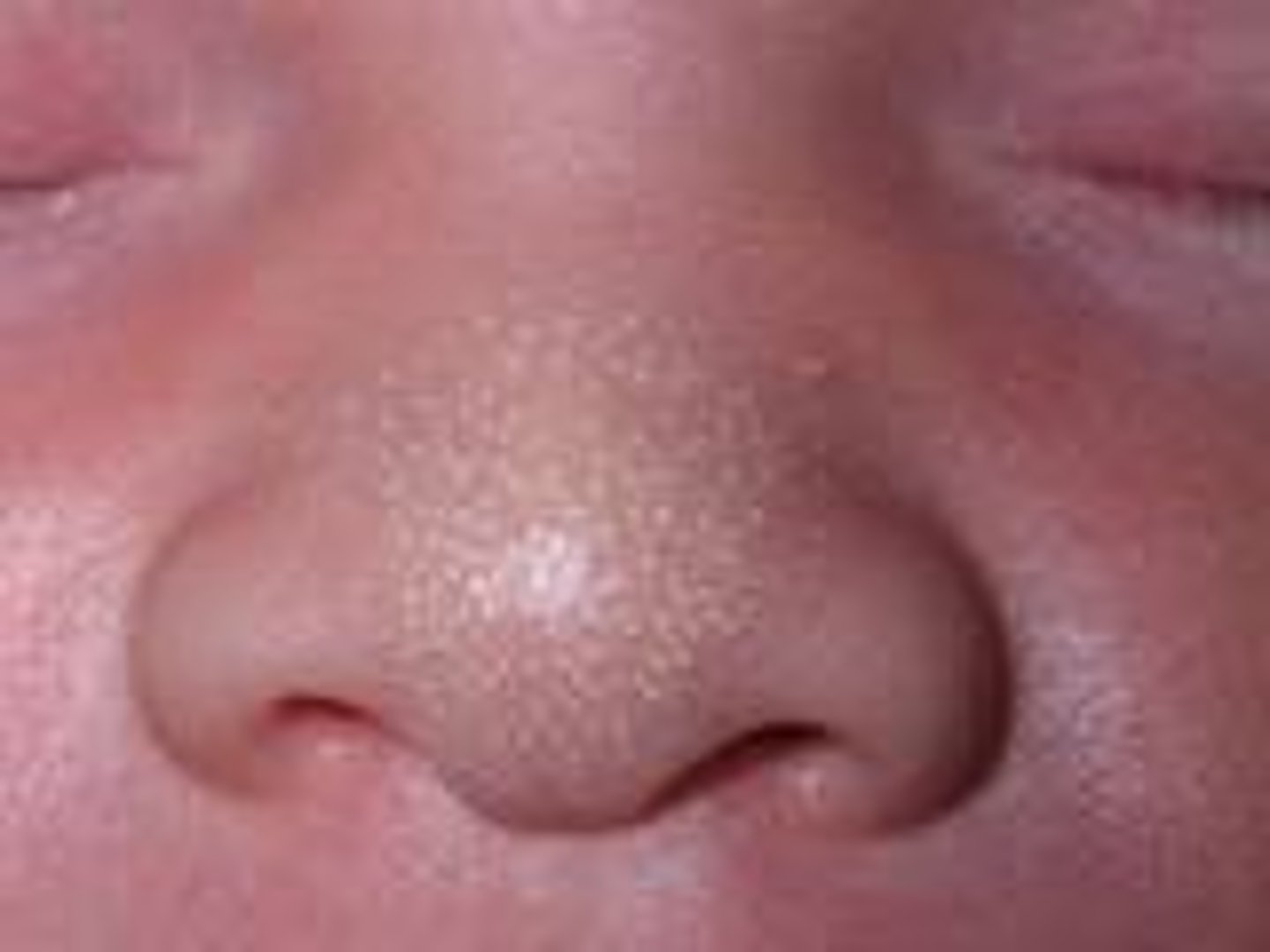 <p>white papules from retained keratin and sebum in follicles on nose and cheeks, may last 2 weeks</p><p>normal</p>
