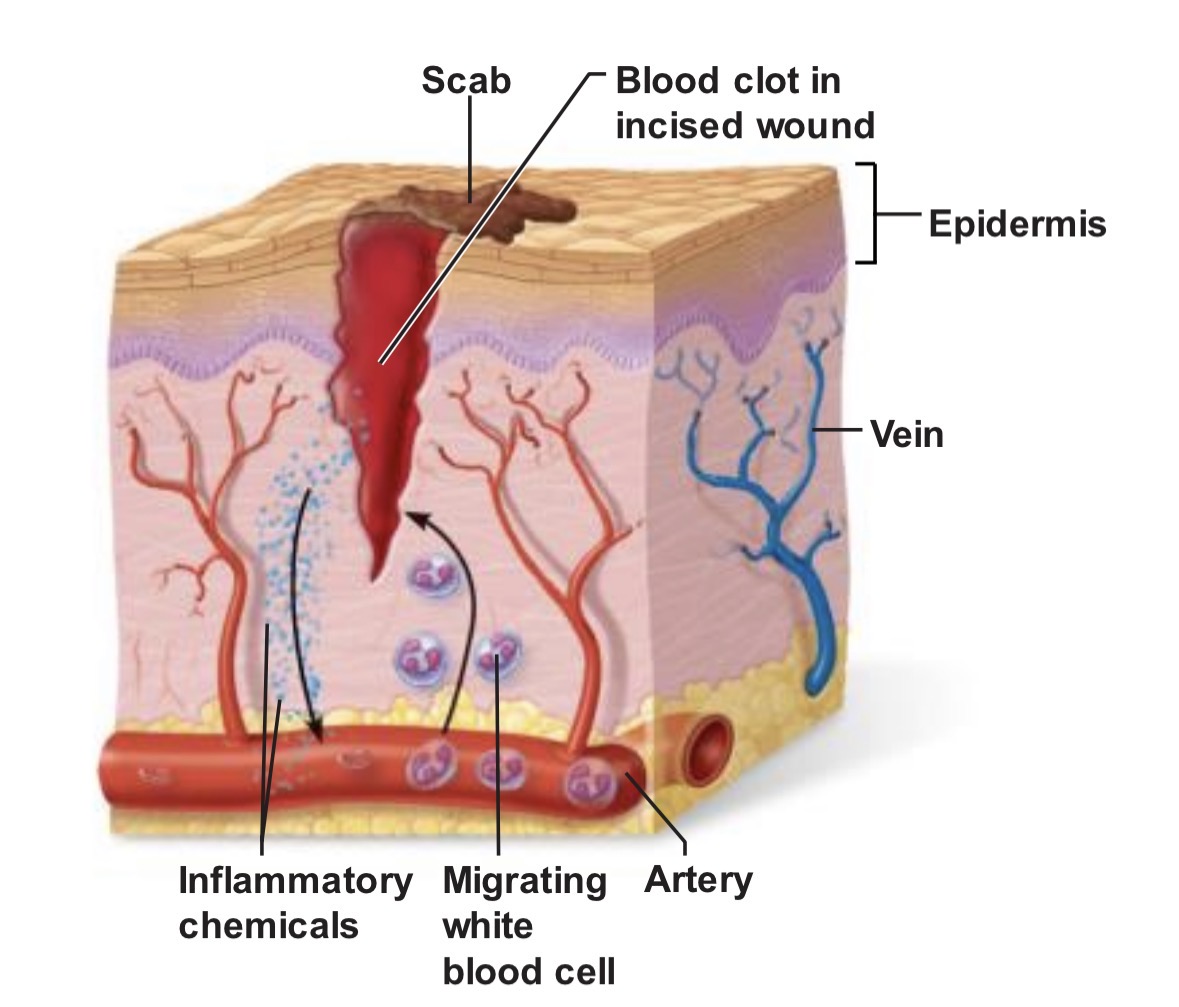 <p><span>Blood vessels bleed, inflammatory chemicals are released, blood vessels become more permeable, and white blood cells and clotting proteins enter the injured area.</span></p>