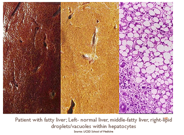 <ul><li><p><strong>Mechanism:</strong> <span style="font-family: "Gill Sans MT";">can indicate reversible damage or may be a sign of intrinsic abnormality in fat metabolism</span></p><ul><li><p><span style="font-family: "Gill Sans MT";">Seen in fatty liver disease (alcohol use, nonalcoholic), diabetes mellitus, obesity</span></p></li></ul></li><li><p><span style="font-family: "Gill Sans MT";"><strong>Organs affected: </strong>liver, kidney, heart, skeletal muscle</span></p></li><li><p><span style="font-family: "Gill Sans MT";"><strong>Gross morphology: </strong> yellow discoloration of an organ</span></p></li><li><p><span style="font-family: "Gill Sans MT";"><strong>Microscopic morphology: </strong>one or several clear vacuoles within the cell</span></p></li></ul><p></p>