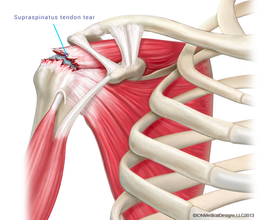 <p>what kind of tear is this? </p>