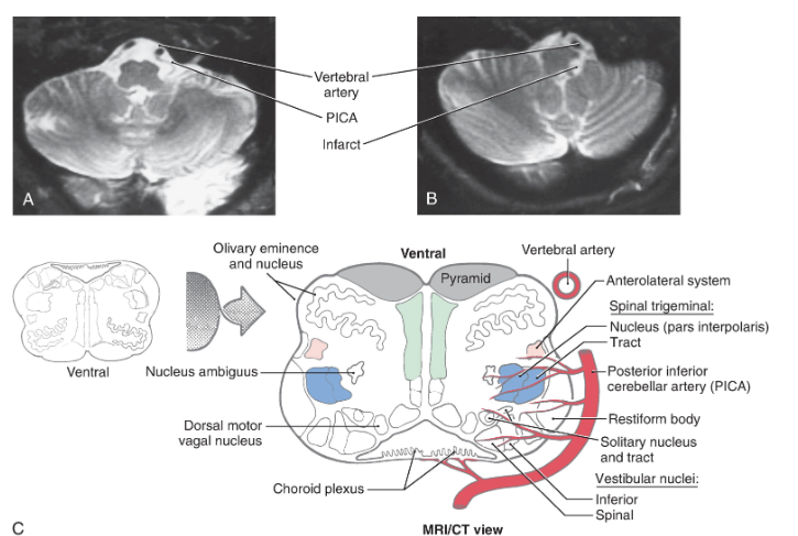 <p>Rostral to the obex, the entire posterolateral medulla is served by branches of the <strong>PICA </strong>( Figs. 11.16B , C and 11.17 ). Included in the territory served by this vessel are the anterolateral system, spinal trigeminal tract and nucleus, vestibular nuclei, solitary tract and nucleus, and nucleus ambiguus. Vascular insufficiency of the PICA territory (or blockage of one vertebral artery) gives rise to a characteristic set of sensory and motor deficits commonly called the <strong>lateral medullary syndrome, PICA syndrome, </strong>or <strong>Wallenberg syndrome </strong>( Fig. 11.17 ). The deficits seen and the corresponding structures involved are (1) contralateral loss of pain and temperature sensation from the body (anterolateral system), (2) ipsilateral loss of pain and temperature sensation from the face (spinal trigeminal tract and nucleus), (3) some vertigo and nystagmus (vestibular nuclei), (4) loss of taste from the ipsilateral half of the tongue (solitary tract and nucleus), and (5) hoarseness and dysphagia (nucleus ambiguus or roots of cranial nerves IX and X) ( Fig. 11.17C ). Patients with the lateral medullary syndrome may also have <strong>Horner syndrome </strong>owing to injury to <strong>hypothalamospinal fibers </strong>descending through the lateral areas of the medulla. We shall further explore the details of these clinical syndromes in later chapters.</p>