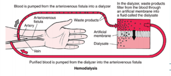 <p>method used to remove waste products such as creatinine and urea from blood</p><ul><li><p>blood cleansed by diffusion across a semipermeable membrane - dialyzer </p></li><li><p>for patients with end stage renal disease</p></li></ul><p></p><p>accesses centeral circulation via AVF, graft or central venous dialysis catheter</p><p></p>