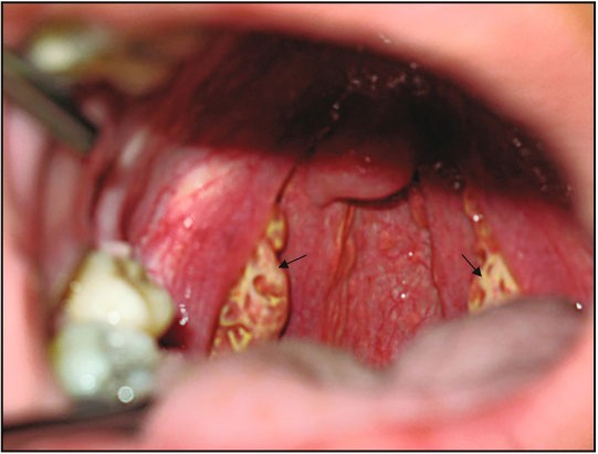 <p>Tangier Disease</p>