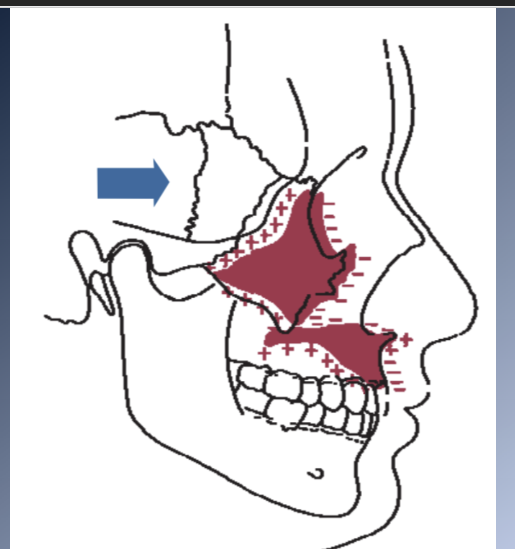 <p><span>Surface remodeling</span><br><span>1. Surface changes can add or subtract from growth at the sutures.</span><br><span>2. Maxilla grows downward and forward</span><br><span>1. Bone is added in the tuberosity area posteriorly, and at the posterior and superior sutures.</span><br><span>2. The anterior surfaces of the bone resorb at the same time.</span></p><p><span>Surface remodeling</span><br><span>3. Distance that the body of the maxilla is moved downward and forward is +25% greater than the forward movement of the anterior surface of the maxilla.</span></p>