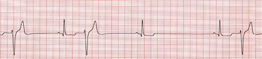 <p><span>The arrhythmia is characterized by bizarre looking QRS complexes with no P or T wave. It is typically associated with slow heart rates and treated with anticholinergics. Please name the arrhythmia shown below. </span></p>