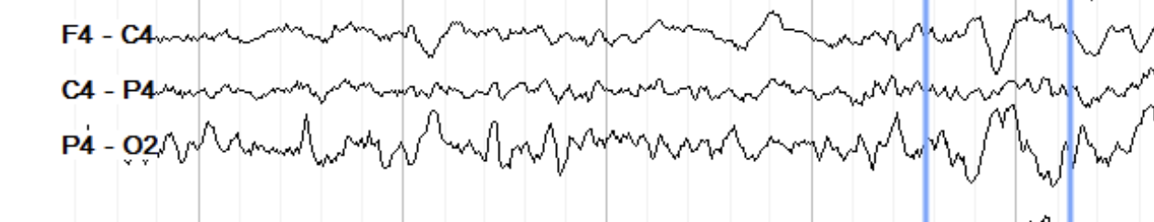 <p>bilateral phase reverse discharges- central, non epleptiform </p>