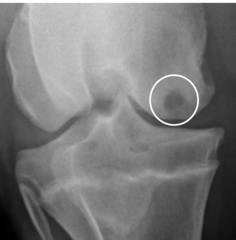 <p>medial femoral condyle</p>