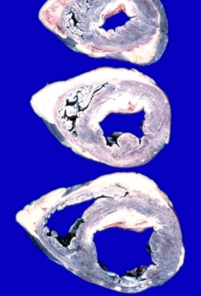 <p>Autopsy of heart showing ventricular hypertrophy and large pale white areas of scar tissue or fibrosis</p>