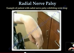 <p>shaft of humerus, radial nerve</p><p>radial nerve palsy</p>