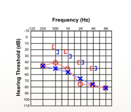 <p>what type of hearing loss</p>