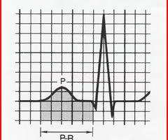 <p><span>measured from the beginning of the P wave to the beginning of the QRS complex and represents the time needed for sinus node stimulation, atrial depolarization, and conduction through the AV node before ventricular depolarization. In adults, the PR interval normally ranges from 0.12 to 0.20 seconds in duration</span></p>
