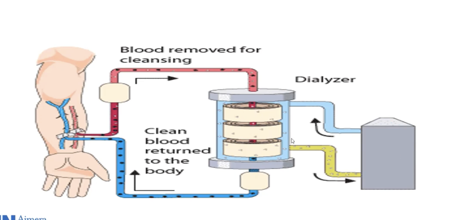 <ul><li><p>Need acess to artery and vein (aka fistula)</p></li><li><p>Blood flows into hemodialyzer and is cleaned of waste products and goes back into patients </p></li><li><p>Helps maintain fluid and electrolytes </p></li></ul><p></p>