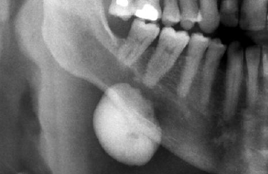 <p>well circumscribed radipaque lesion </p>