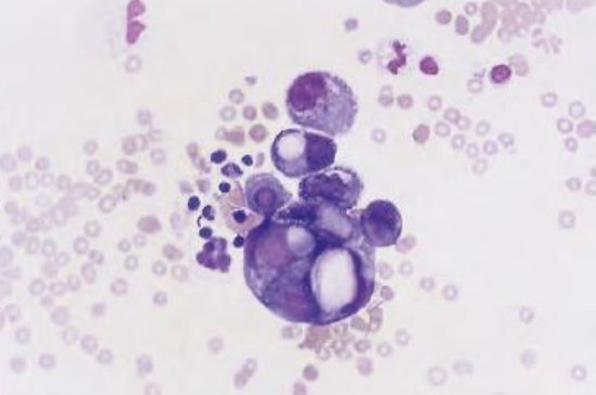 <p><strong><u>Ascitic Fluid Cells: Peritoneal Fluid</u></strong></p><ul><li><p>Containing <span style="color: yellow;">mucin vacuoles</span> and nuclear irregularities </p></li></ul><p></p>