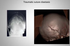 <p>Diastasis</p>