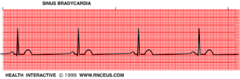 <p>-P for every QRS, could be INVERTED</p><p>-Narrow QRS</p><p>-Regular </p><p>-Rate <60 bpm</p>