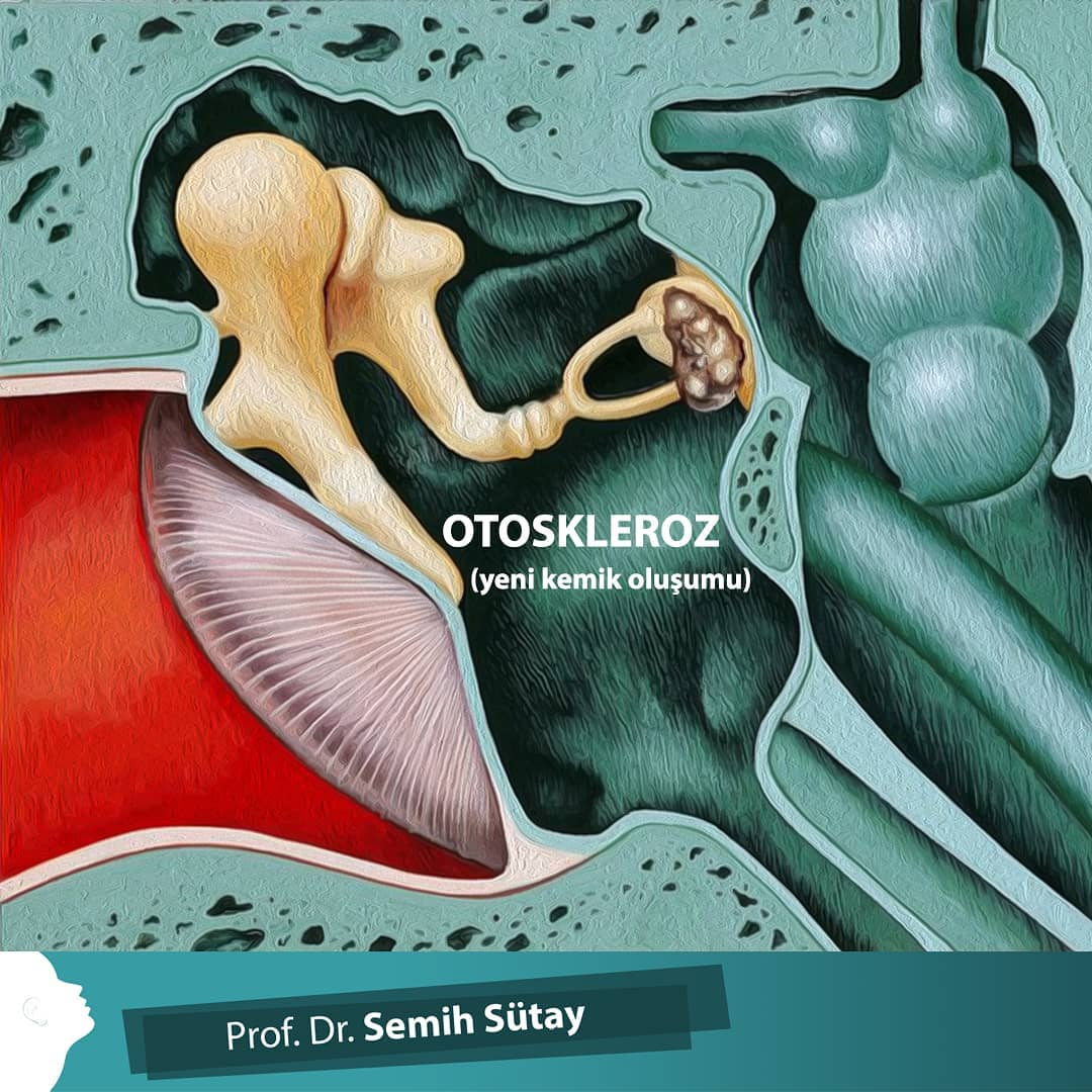 <ul><li><p>Soundwaves entering the ear canal cannot be transmitted across the eardrum into the inner ear.</p></li></ul><p><strong>Temporary causes</strong>: Ear wax buildup, ruptured eardrum</p><p><strong>Permanent causes</strong>: Otosclerosis - inner ear bones (Maleus, incus &amp; stapes) become malformed and cannot vibrate</p><ul><li><p>Stapes fuses to oval window</p></li><li><p>Maleus, incus and stapes become fused in some form, preventing vibration</p></li></ul><p></p><p><strong>Conductive hearing loss: </strong>Soundwaves cannot be “conducted” to the cochlea</p>