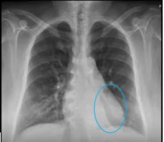 <p>left lower lobe</p>