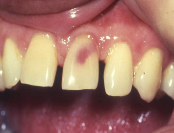 <p>internal resorption affecting crown </p>