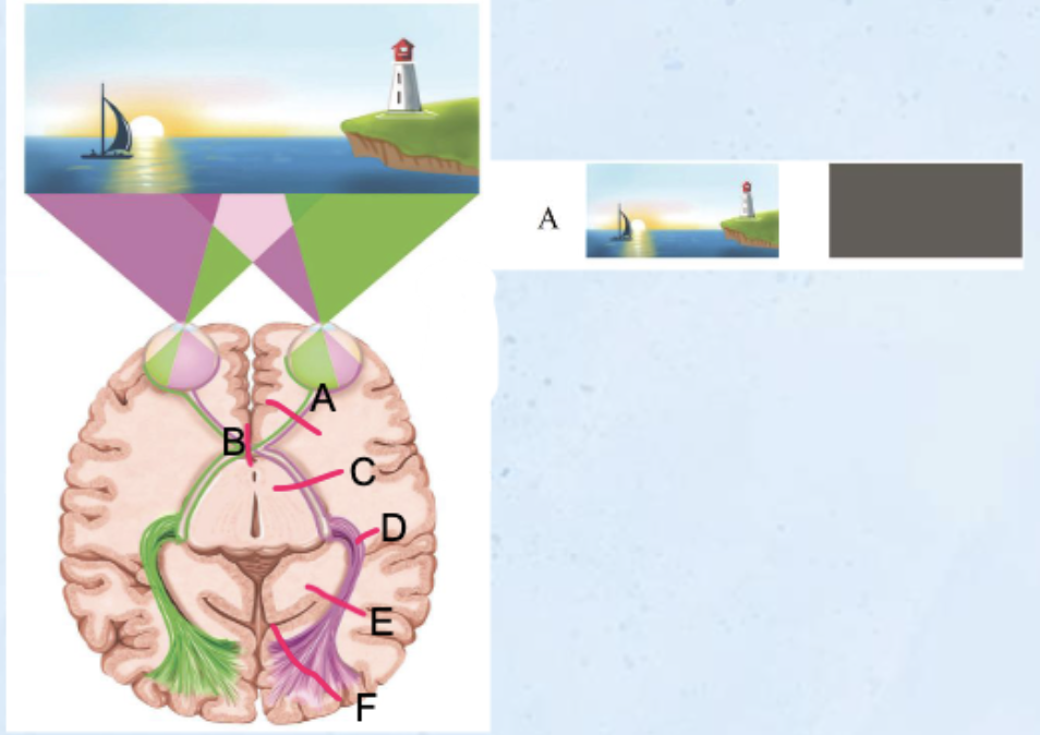 <p><strong>CN II Optic Nerve</strong></p>