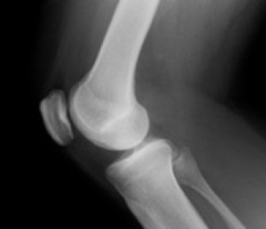 <p>diagnosis: XR to r/o fracture</p><p>treatment: immobilization, crutches</p>