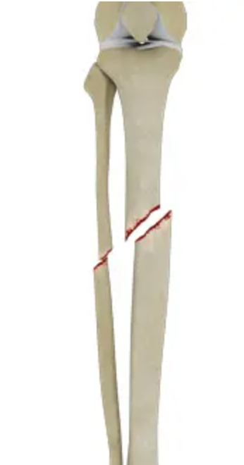 <p>Where is this fracture? (tibia)</p>