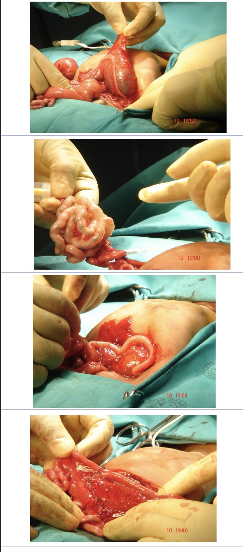 <ol><li><p>Resuscitation </p></li><li><p>Nasogastric tube </p></li><li><p>Surgery> resection, anastomosis, injection of water / air</p></li></ol><p></p>