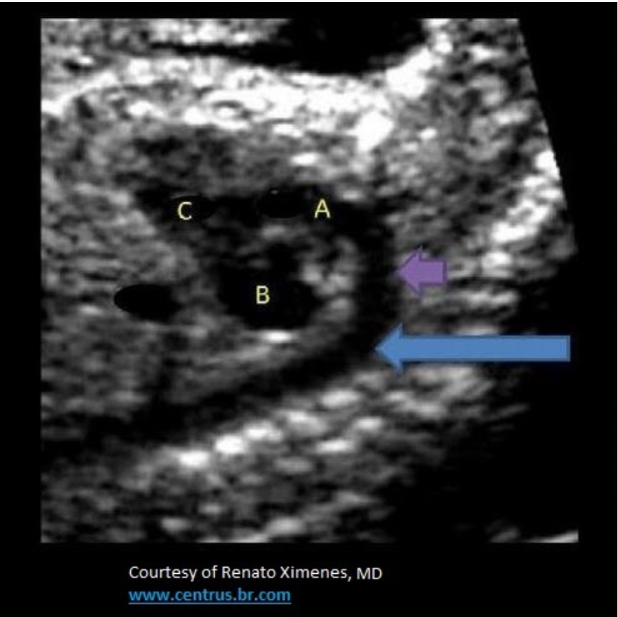 <p>The blue arrow indicates which structure?</p><p>A. aortic arch</p><p class="p1">B. main pulmonary artery</p><p class="p1">C. descending aorta</p><p class="p1">D. ascending aorta</p>