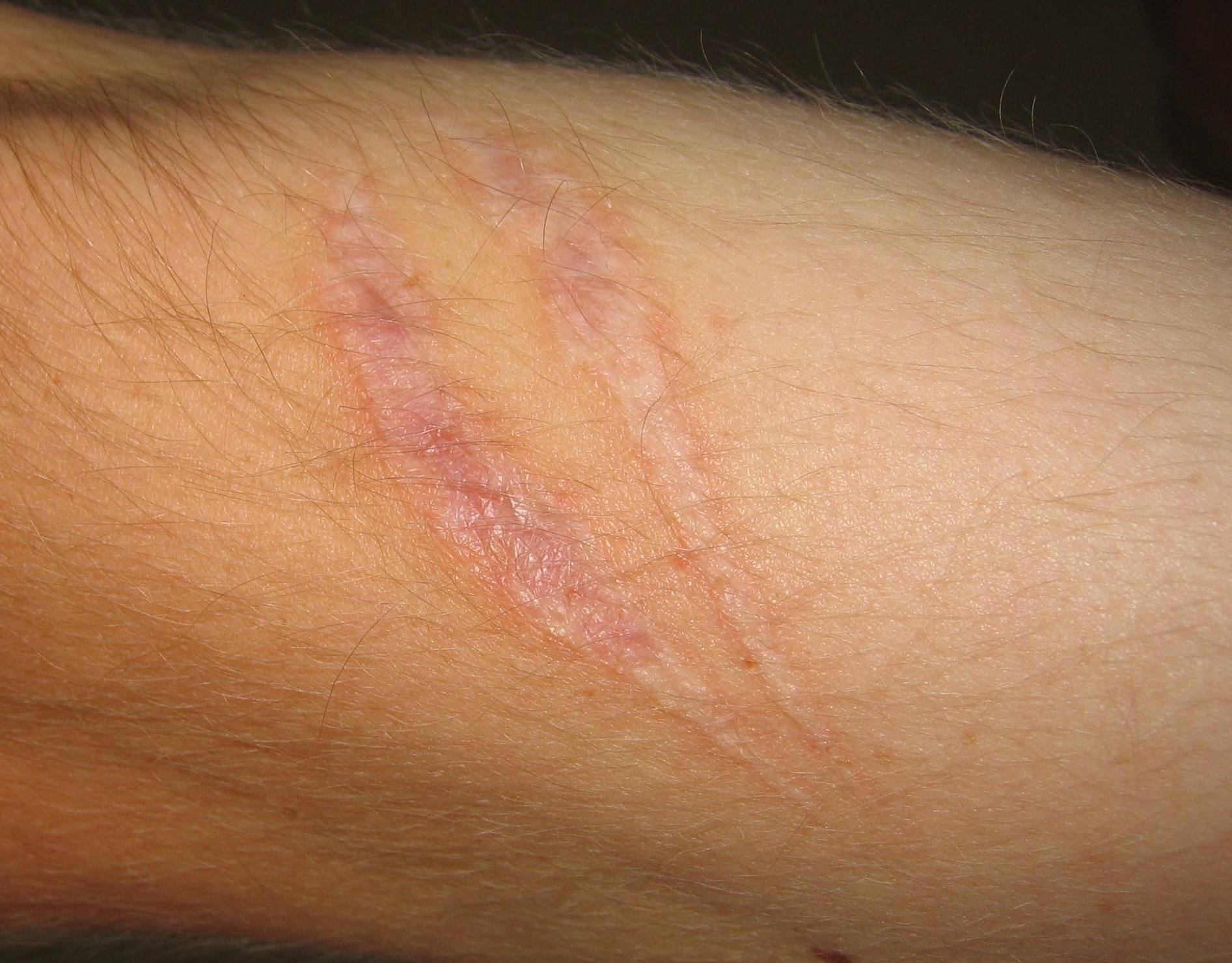 <p><strong>Definition: </strong>is <mark>a permanent mark left on the skin or other tissue after a wound, burn, or sore has healed</mark>. It is a natural part of the body's healing process, created when fibrous tissue (collagen) replaces the damaged skin</p>